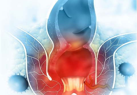 Có những dấu hiệu nào cho thấy áp xe hậu môn đã tái phát?